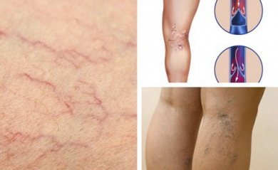 4 Naturheilmittel gegen Besenreiser und Krampfadern