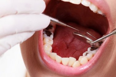 6 natürliche Mittel zur Vorbeugung von Karies