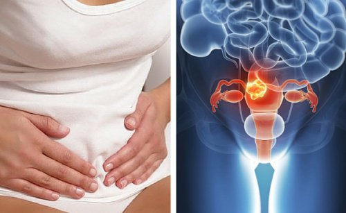 Mögliche Symptome für Gebärmutterhalskrebs