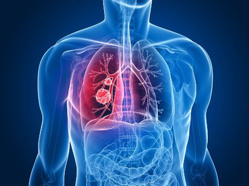 Lungenkrebs erkennen: Die häufigsten Symptome