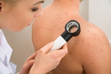 Naturheilmethoden gegen Pickel am Oberkörper