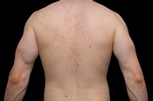 Naturheilmittel gegen Pickel am Rücken
