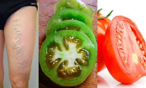 Tomaten zur Linderung der Schmerzen bei Krampfadern