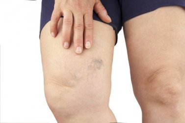 Entwässernd wirkende Hausmittel: Schnelle Hilfe