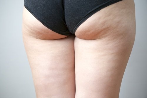 Cellulite durch regelmäßiges Gehen bekämpfen