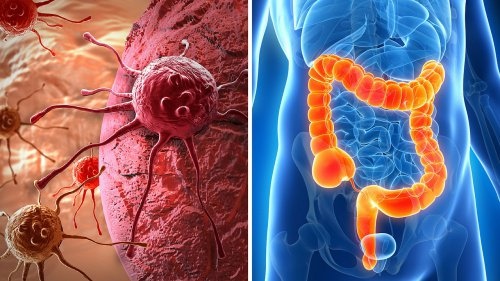 Verarbeitetes Fleisch und Darmkrebs