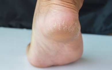 4 selbst gemachte Cremes gegen trockene Fersen