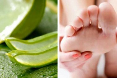 Fußpilz mit Aloe Vera behandeln