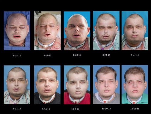 Gesichtstransplantation