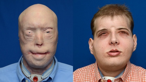 Historische Gesichtstransplantation