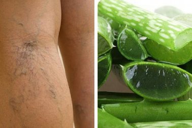 Ergänze die Therapie deiner Krampfadern mit Aloe Vera