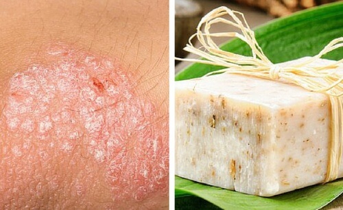 Selbstgemachte Seife zur Behandlung von Ekzemen der Haut