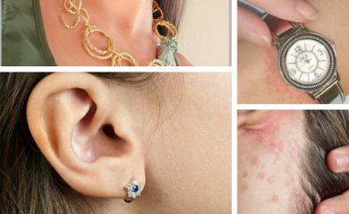 Schmuckallergie - Was hilft?