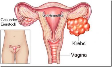 Was du über Eierstockkrebs wissen solltest