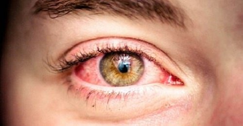 Rote-Augen