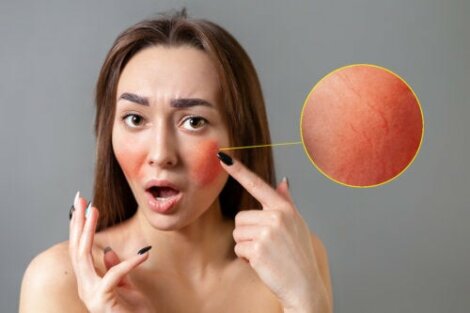 Behandlung und Tipps gegen Rosacea