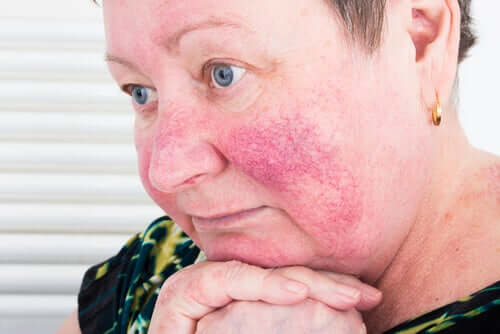 Frau mit Rosacea