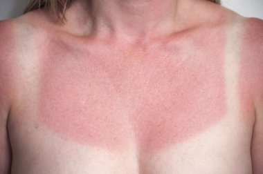 5 Hausmittel, die Sonnenbrand lindern könnten
