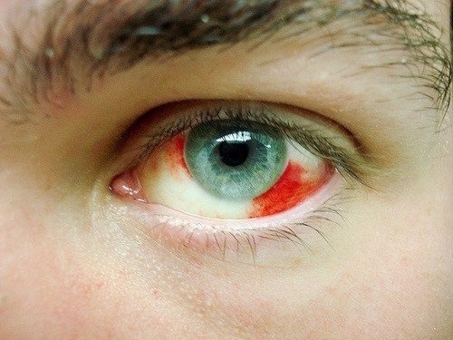 Warum kommt es zu Augenblutungen?