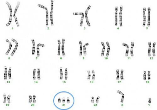 Trisomie-21