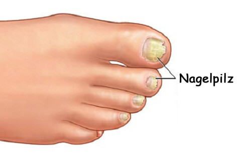 Nagelpilz
