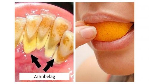 5 natürliche Mittel zur Entfernung von Zahnbelag