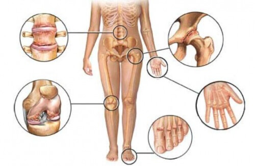 6 Naturheilmittel zur Linderung von Arthritis - Schmerzen