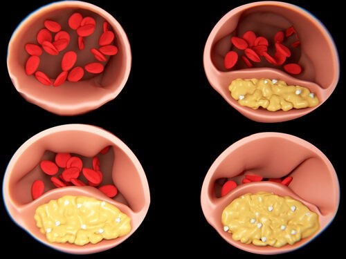 Auberginenwasser gegen erhöhte Cholesterinwerte