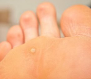 Plantarwarzen mit Apfelessig und Zitrone behandeln