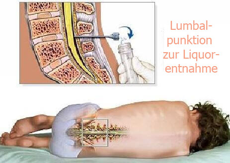 Rückenpunktion zur Vorsorge gegen Gehirntumore