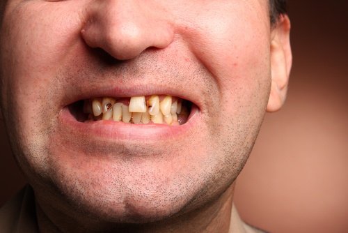 Schlechte-Zähne
