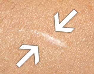 Die besten Hausmittel zur Wundheilung