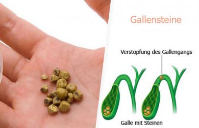 7 natürliche Getränke gegen Gallensteine