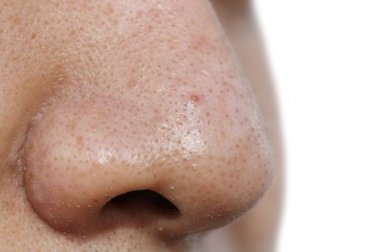 5 Gesichtsmasken gegen Mitesser
