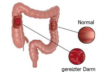 Empfehlenswerte Ernährung bei Reizdarm