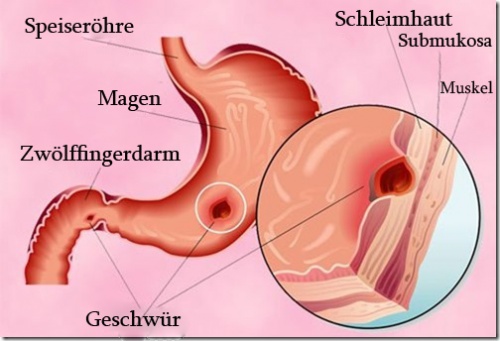 Magengeschwür und rechtsseitige Bauchschmerzen