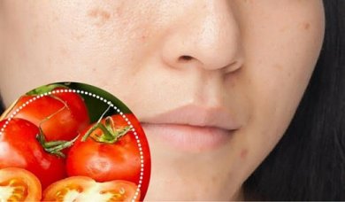 6 Naturprodukte gegen Gesichtsflecken