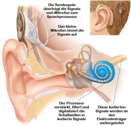 Cochleaimplantat