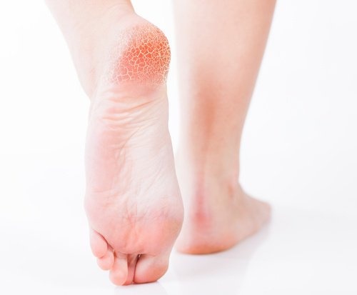 Rissige Fersen: Peeling und Pflegebehandlung