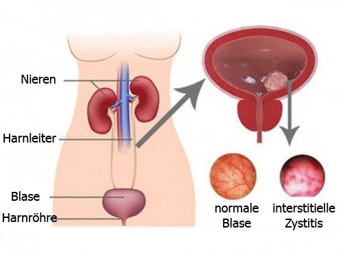 8 Heilmittel gegen Zystitis