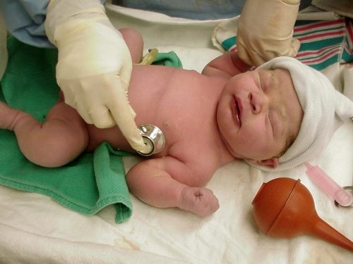 Baby nach Kaiserschnitt
