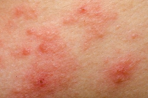 Dermatitis