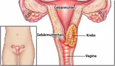 Vorsorge von Gebärmutterhalskrebs