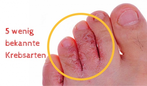 5 wenig bekannte Krebsarten