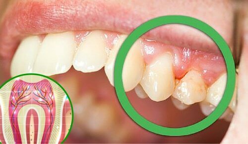 5 Gründe für Zahnschmerzen