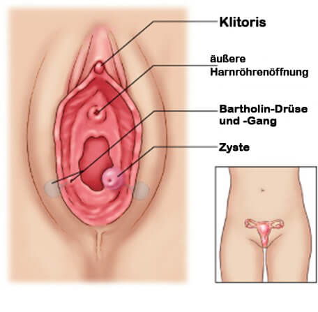 Bartolinitis
