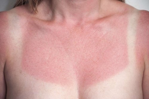 Vorzüge von Apfelessig: Gegen Sonnenbrand
