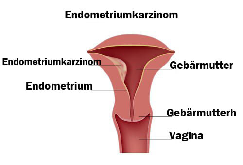 Endometriumkarzinom
