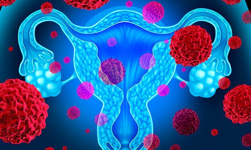 Endometriumkarzinom: 5 wissenswerte Aspekte Endometriumkarzinom: 5 wissenswerte Aspekte
