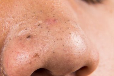 5 Hausmittel zur Bekämpfung von Mitessern